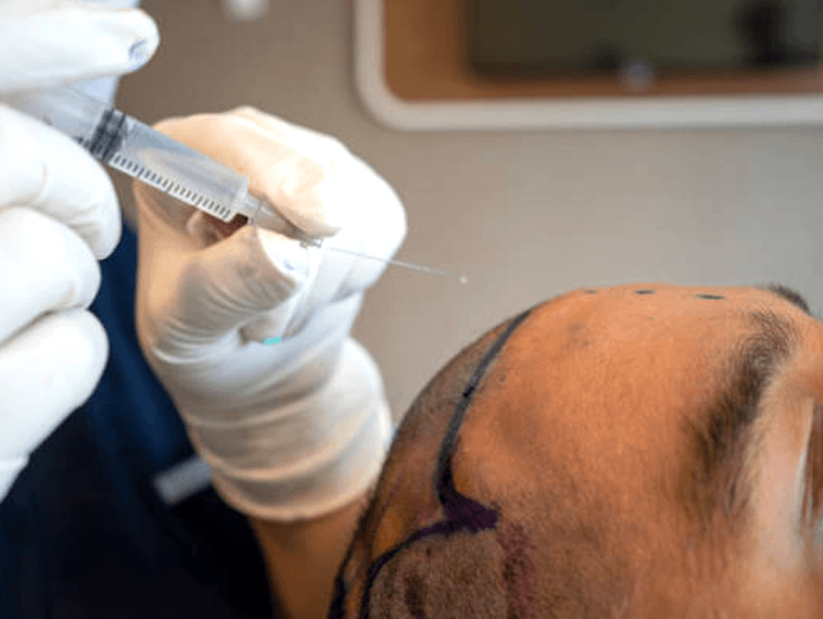 what-FUE-Hair-Transplant