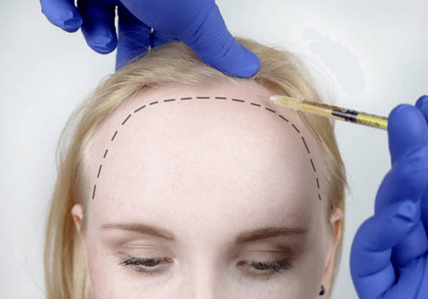 women-hair-transplant-v1
