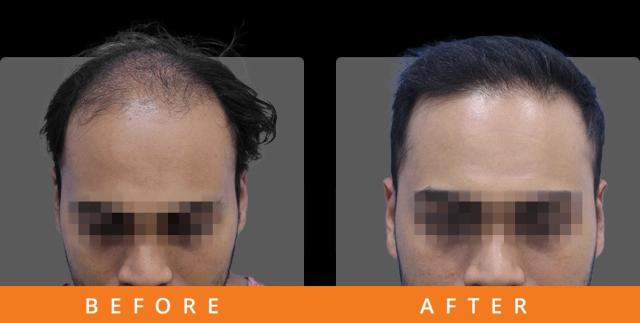 3400-grafts-transplant