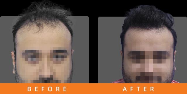6200-grafts-result-bangalore