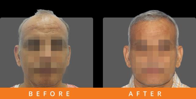 hair-transplant-50-year-old-results