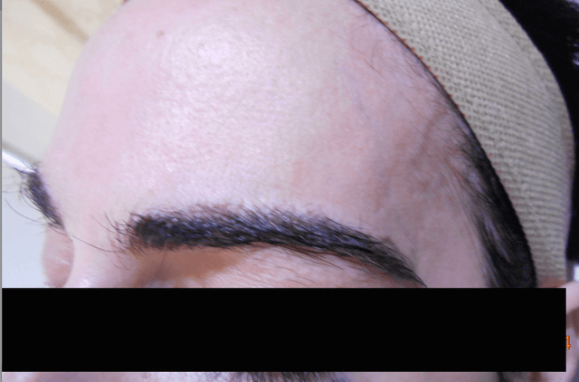 Reconstruction of eyebrows with Revision-FUE