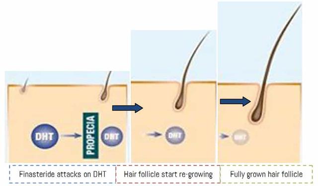 Finasteride: Dosage, Uses &#038; side effects for hair Loss