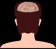 SMP Treatment