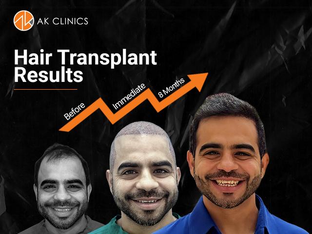 Hair Transplant Cost in Delhi (2025): Graft-Wise Pricing, Techniques &#038; Full Cost Breakdown