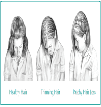 hair loss thyroid