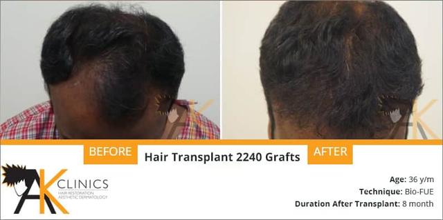 2240 Grafts With Bio Fue Result