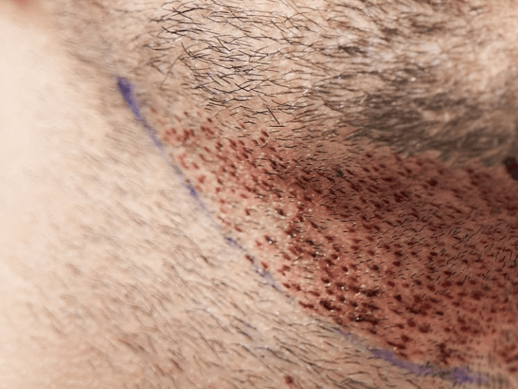 cost-beard-transplant