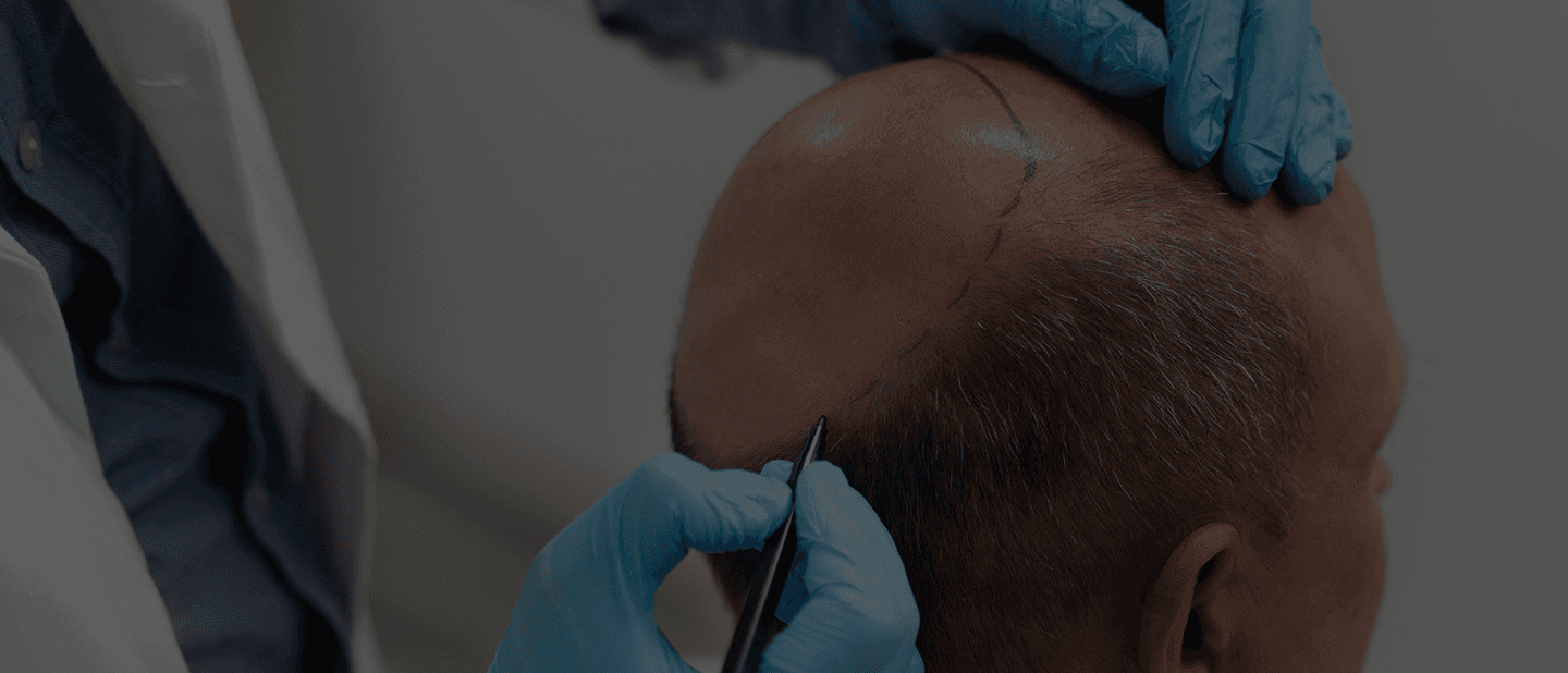 fut-hair-transplant