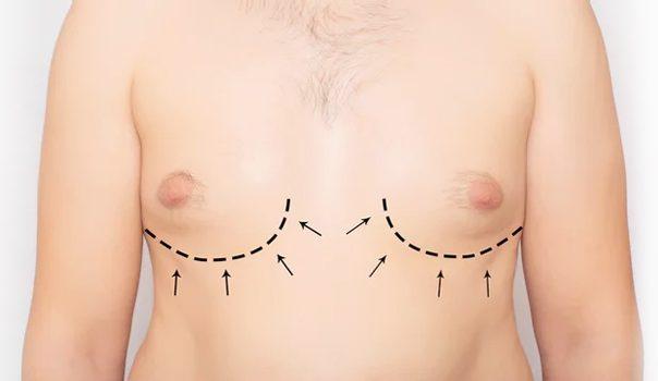 gynecomastia-banner