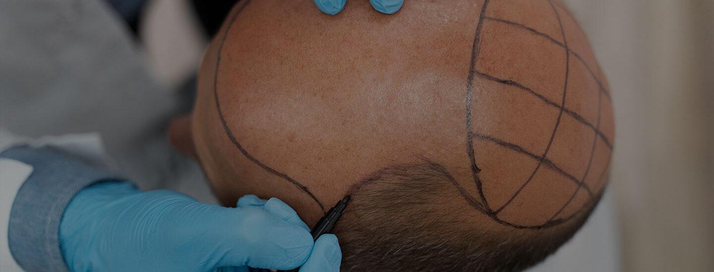 Hair Transplant Surgeon in Delhi