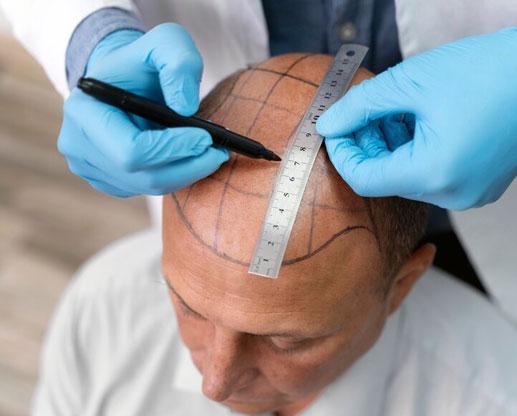 hair-transplant-technique