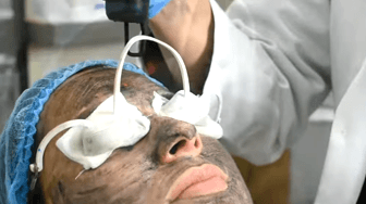 Carbon-Facial-Procedure-at-AK-Clinics