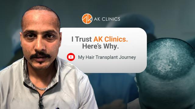 2100 Grafts Hair Transplant Journey
