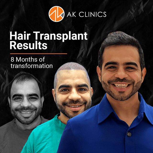Gaurav Wasan’s Hair Transplant Journey: The Results That Truly Restored His Confidence