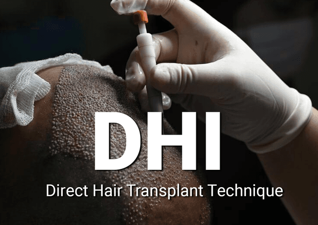 Direct hair transplant technique