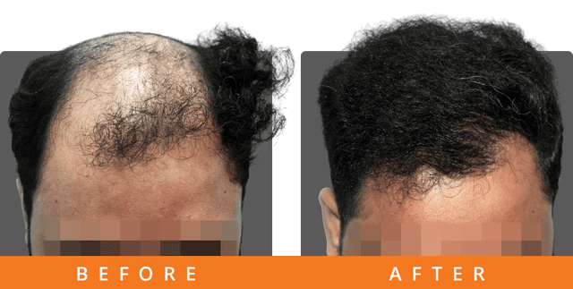 Atul - Delhi - 4000 Grafts results after 10 Months