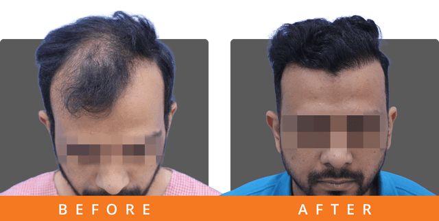 Ashwat - Hair transplant result Bangalore