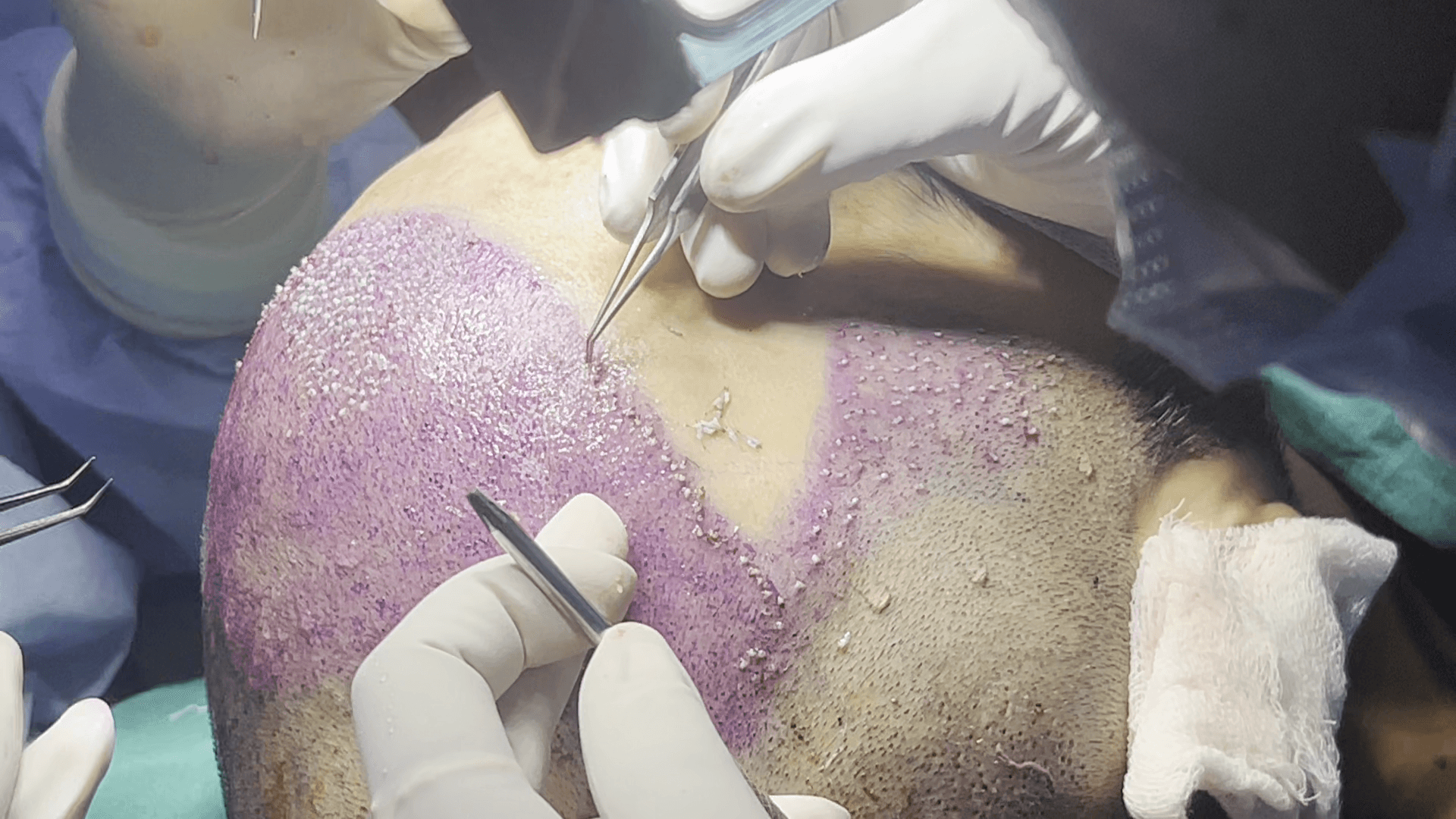 hair-implantation-session-2