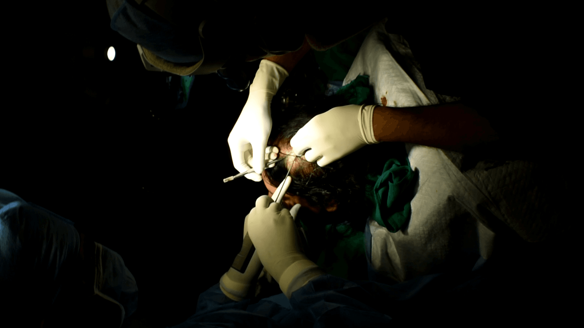 hair-transplant-traning