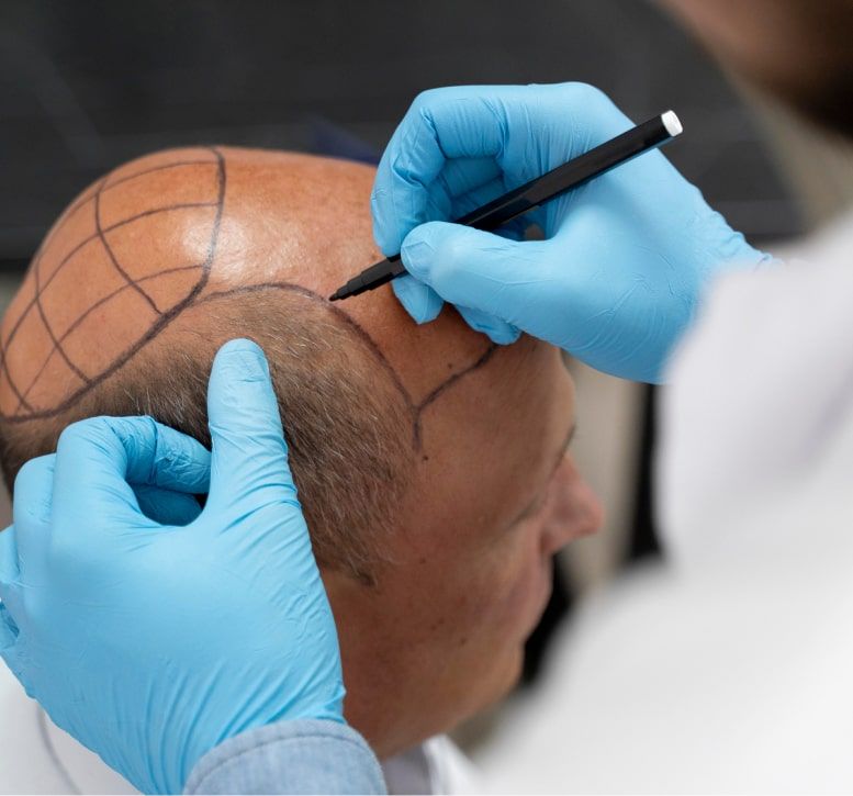 laser hair removal - faq