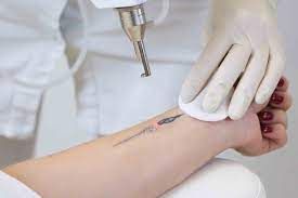 laser hair removal - faq