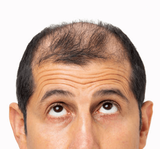laser hair removal - faq