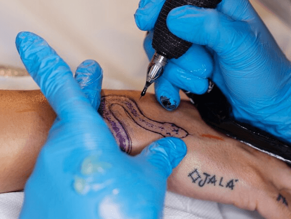 laser hair removal - faq
