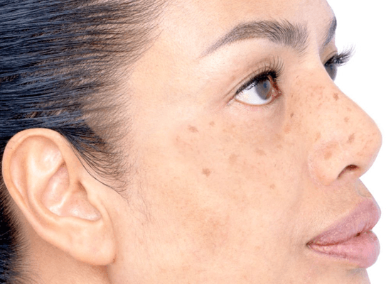laser hair removal - faq