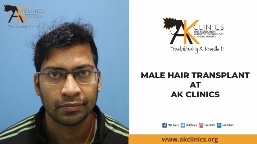 Hairline Reconstruction Surgery with 2500 Grafts | Patient Experience