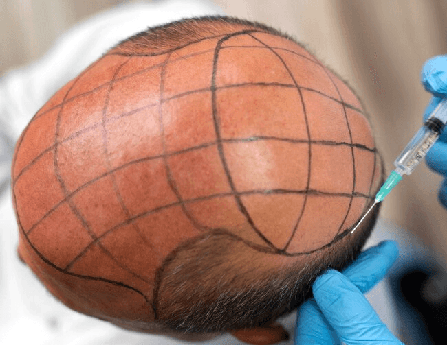 implantation