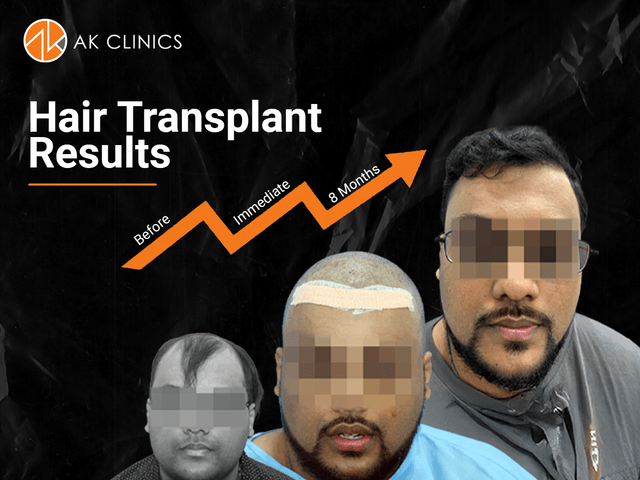 hair transplant cost punjab