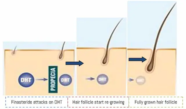 Finasteride: Dosage, Uses & side effects for hair Loss
