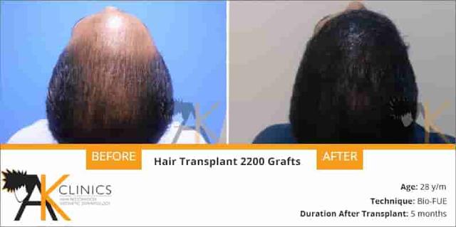 result 2200 grafts