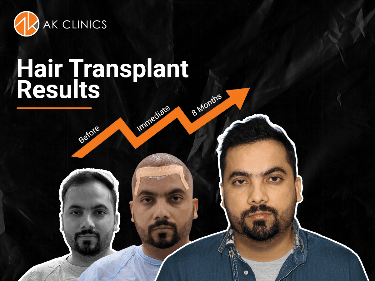 hair-transplant-cost-bangalore