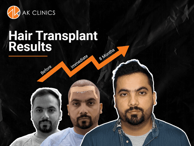 hair-transplant-cost-bangalore