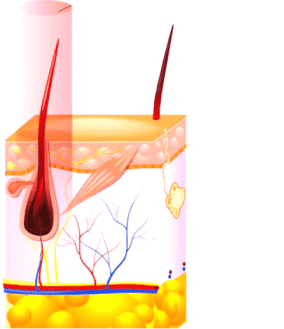 Laser hair removal procedure - light absorbed by hair pigment converting into heat