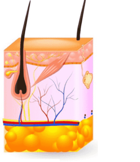 Laser hair removal in Delhi - laser beam penetrating skin to reach hair follicle