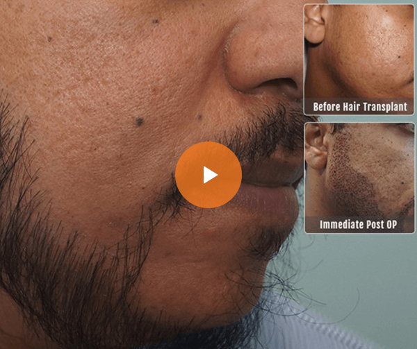 beard-transplant-surgery-video
