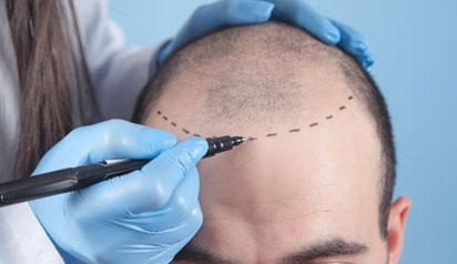 Hair transplant Men