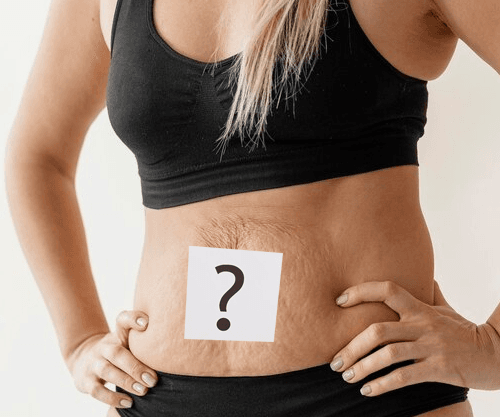 stretch-marks-faq