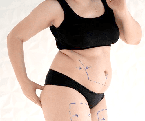 stretch-marks-risks-side-effects