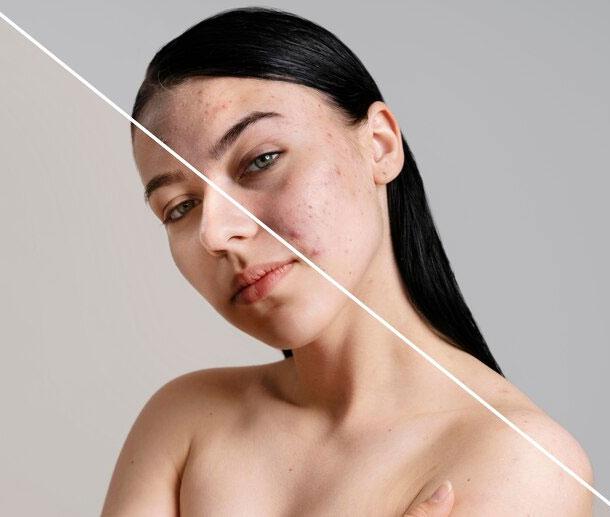 what-is-acne-treatment