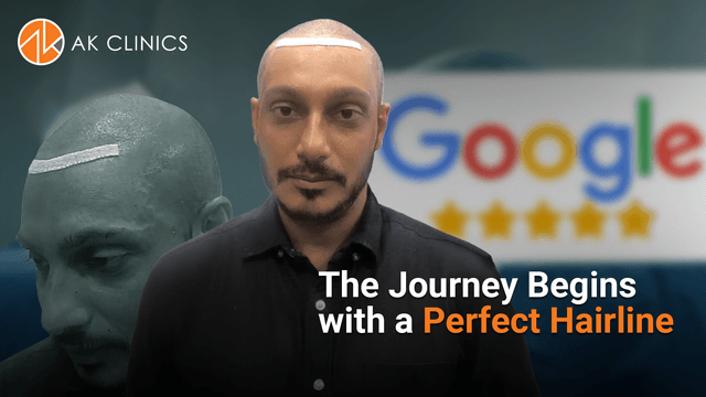 3300 grafts hair transplant