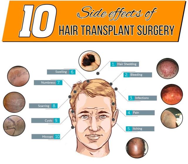 Hair Transplant Side Effects: Complete Guide for Patients (2026)