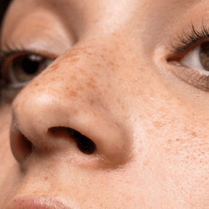 Hyperpigmentation-problem