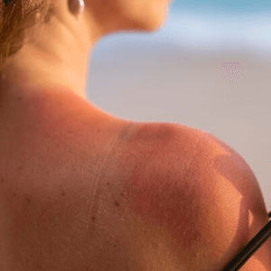 Sunspots-pigmentation-problem