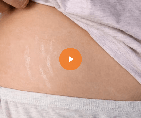 stretch-marks-video