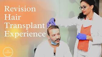 Revision Hair Transplant Experience at AK Clinics